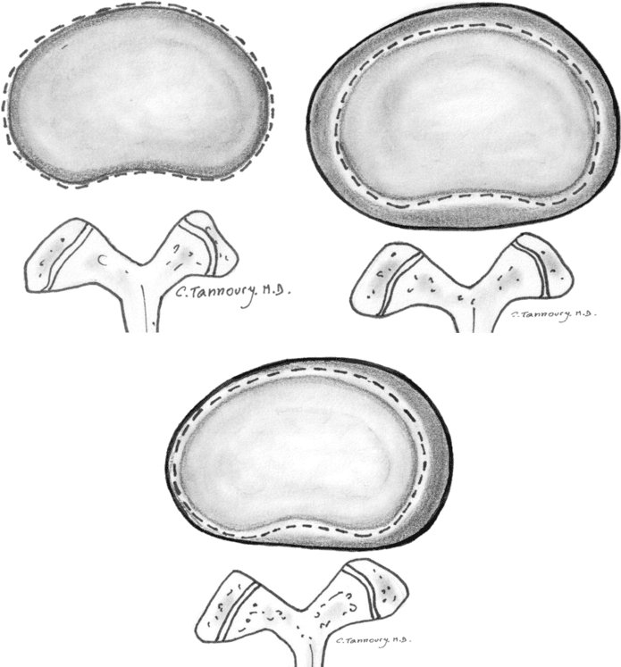 simetrično in nesimetrično  izbočen disk