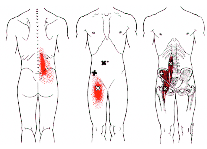 trigger point za kolk