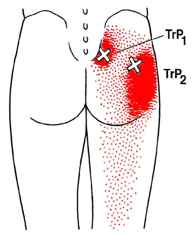 Piriformis sindrom in bolečina v ritnici